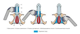 low intensity shockwave therapy for erectile dysfunction