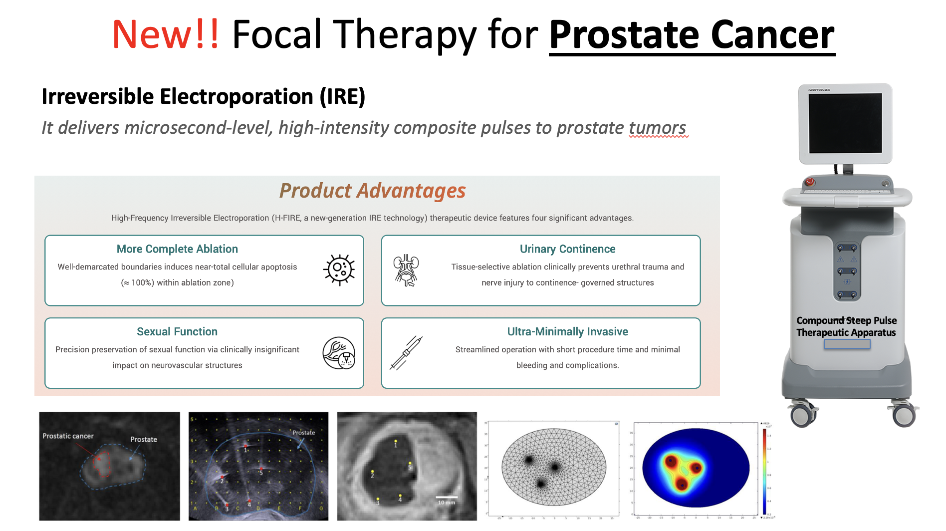 New localised prostate cancer treatment- IRE (Focal Therapy)